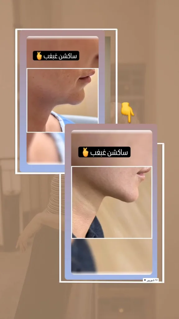 نمونه ساکشن غبغب کلینیک زیبایی نوین لیزر تبریز