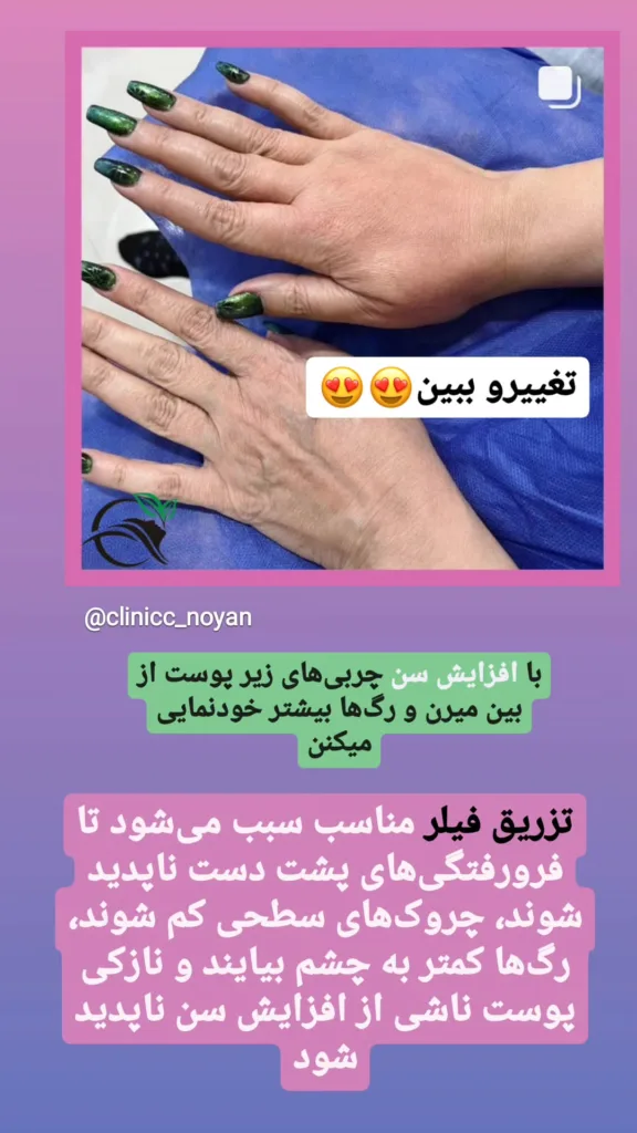 نمونه جوانسازی دست کلینیک زیبایی نویان اراک