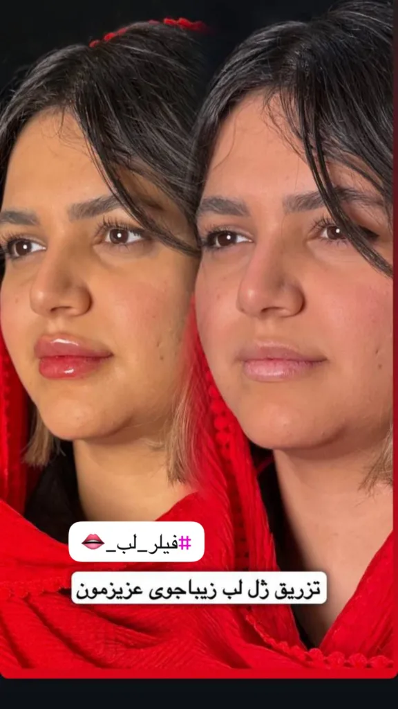 نمونه تزریق ژل کلینیک زیبایی دکتر نبی زاده (مهتاب) بندرعباس