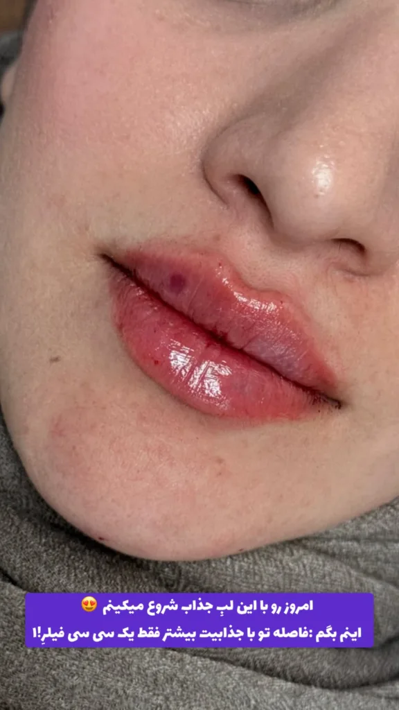 نمونه تزریق ژل کلینیک زیبایی دکتر نبی زاده (مهتاب) بندرعباس