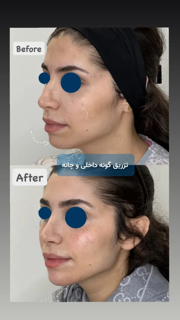نمونه تزریق گونه زیبایی دکتر نبی زاده (مهتاب) بندرعباس
