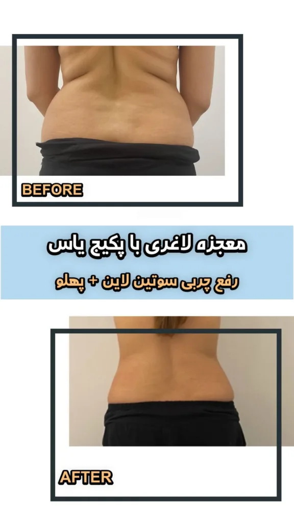 نمونه لاغری کلینیک زیبایی یاس بندرعباس