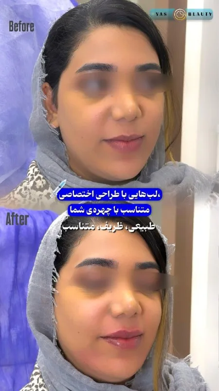 نمونه فیلر لب کلینیک زیبایی یاس بندرعباس