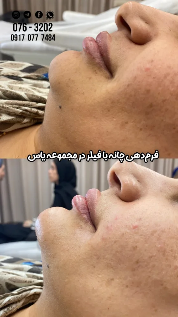 نمونه تزریق فیلر چانه کلینیک زیبایی یاس بندرعباس