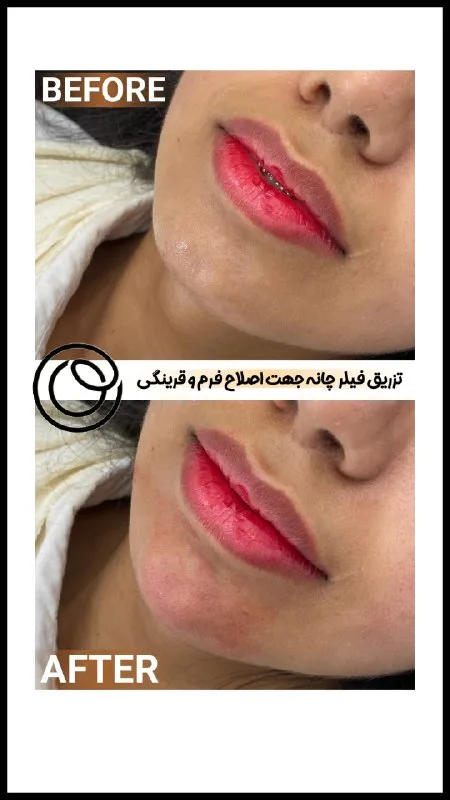 نمونه تزریق فیلر چانه کلینیک زیبایی یاس بندرعباس