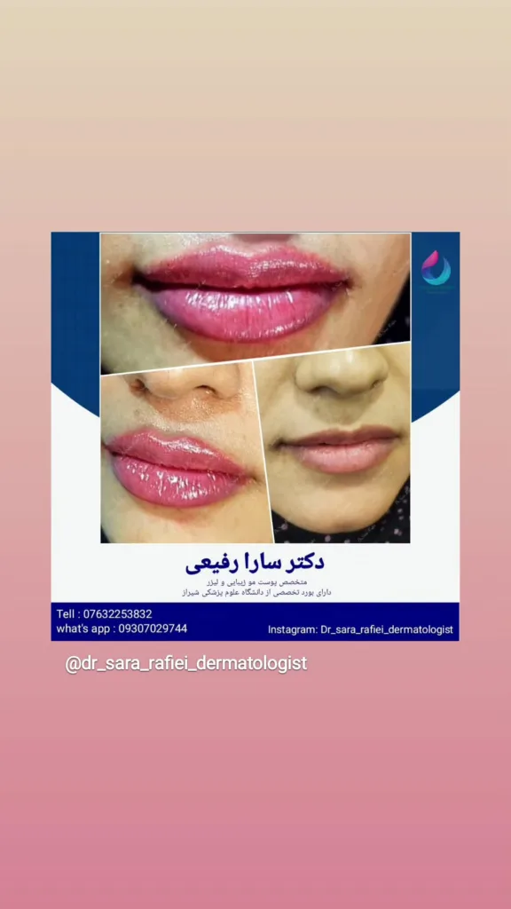 نمونه فیلر لب کلینیک زیبایی دکتر سارا رفیعی بندرعباس