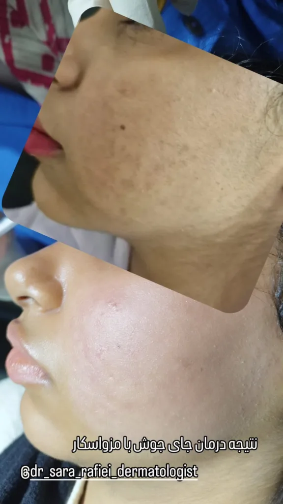 نمونه مزوتراپی کلینیک زیبایی دکتر سارا رفیعی بندرعباس