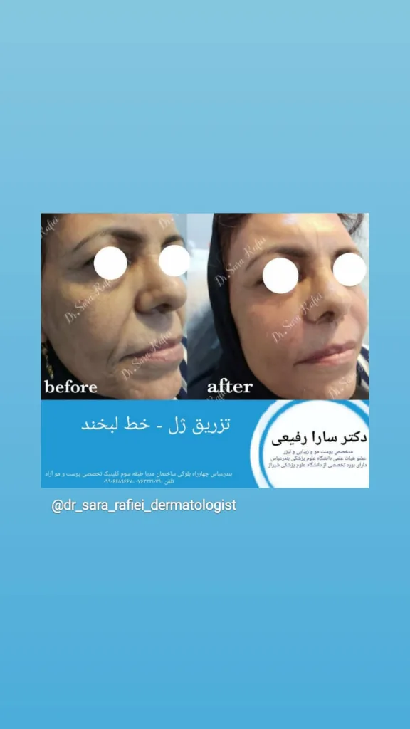 نمونه تزریق ژل خط خنده کلینیک زیبایی دکتر سارا رفیعی بندرعباس