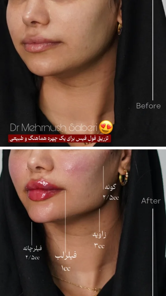نمونه کانتورینگ کلینیک زیبایی دکتر مهرنوش صابری بندرعباس
