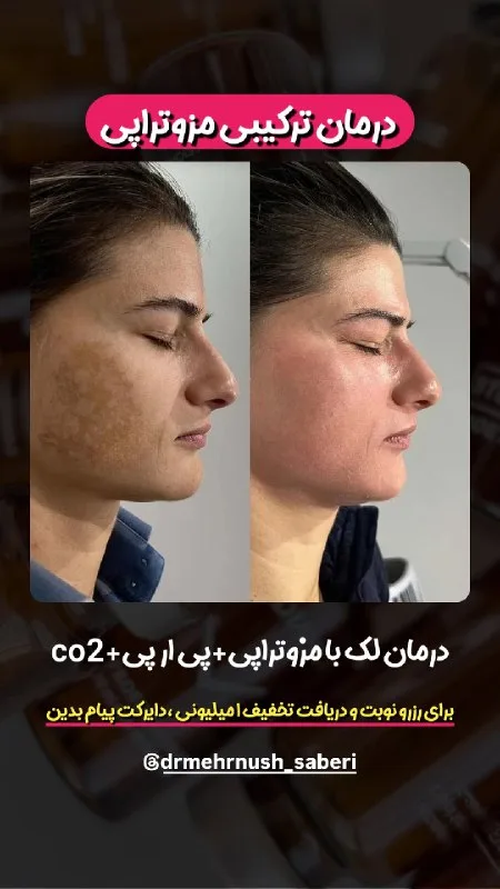 نمونه مزوتراپی کلینیک زیبایی دکتر مهرنوش صابری بندرعباس
