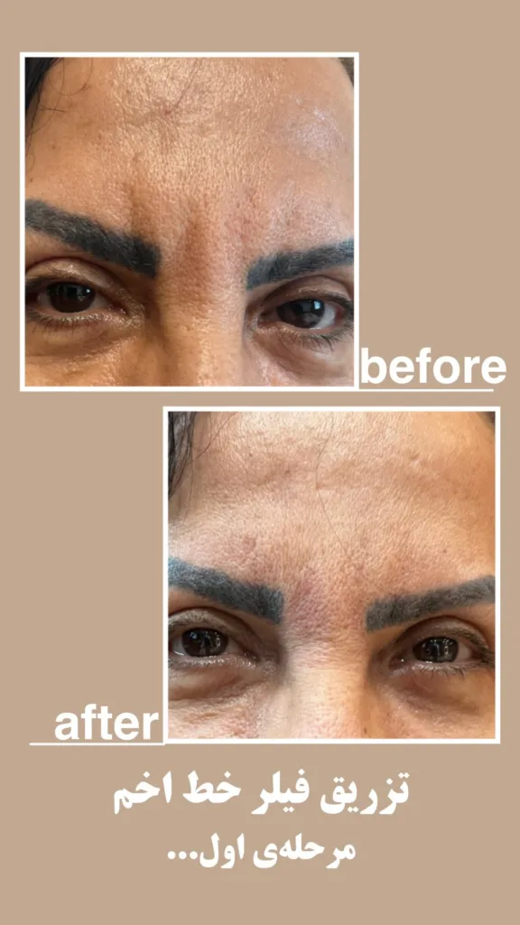 نمونه اسکارسالک مرکز لیزر پارسیان بندرعباس