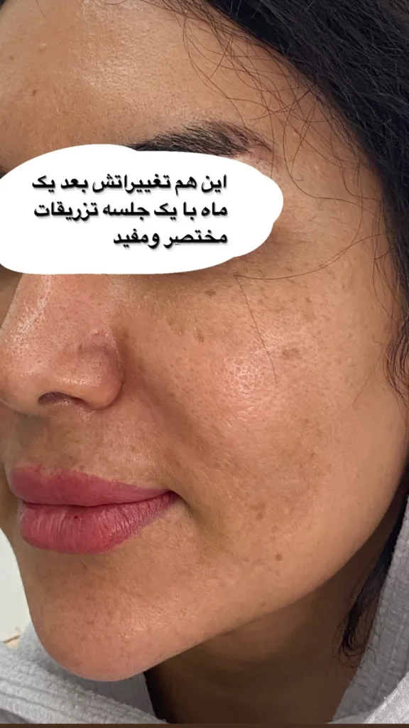 نمونه جوانساز کره ای کلینیک زیبایی دکتر مرضیه آقابابایی بندرعباس