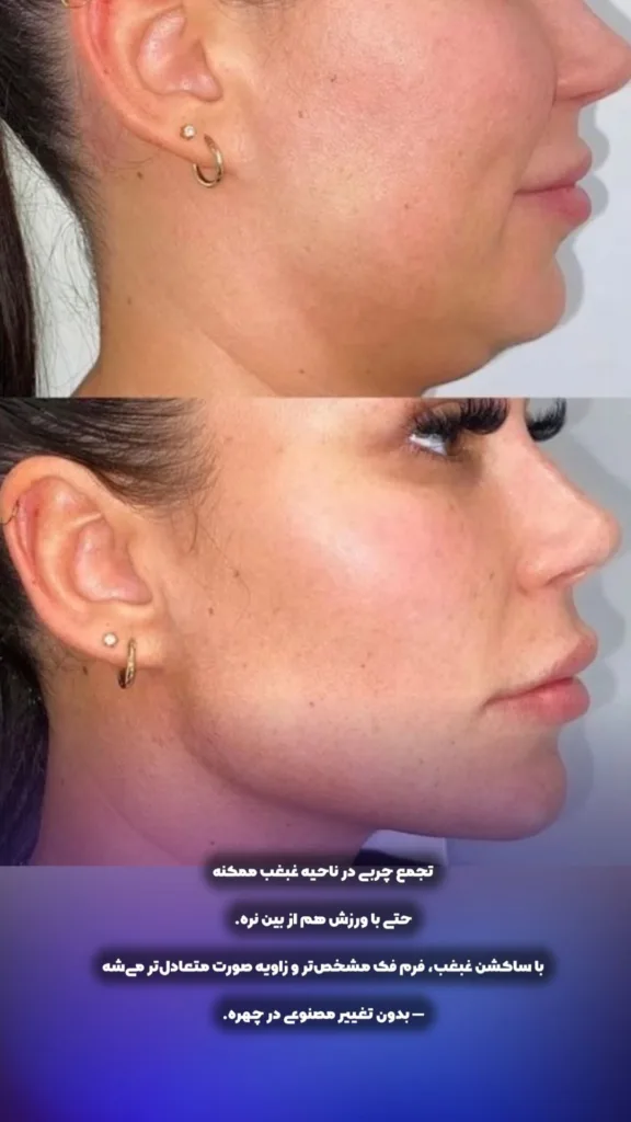 نمونه ساکشن غبغب کلینیک تخصصی پرمون (دکتر جیحانی) بندرعباس