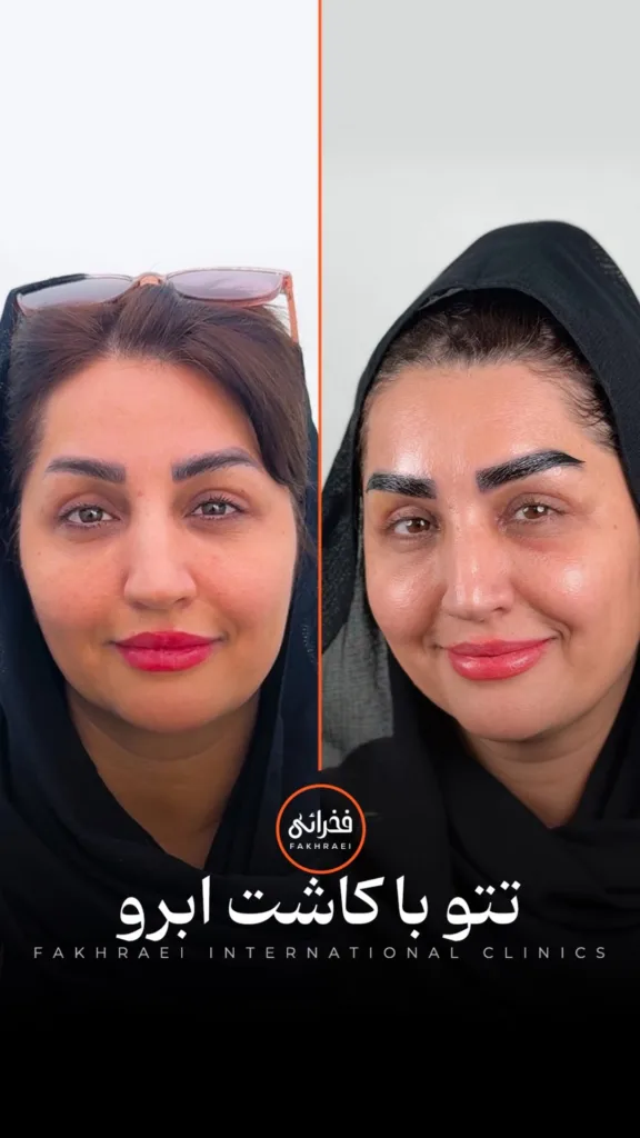 نمونه کاشت ابرو کلینیک زیبایی فخرائی بندرعباس