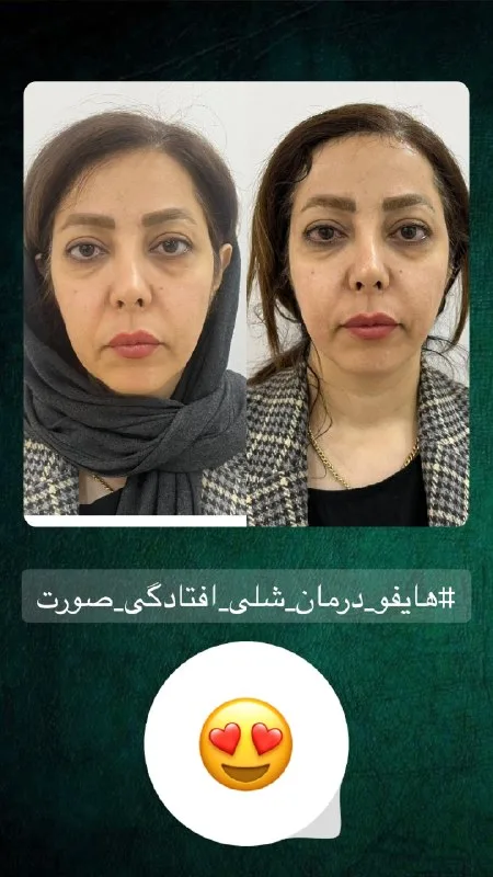 نمونه هایفو کلینیک زیبایی دکتر فاطمه دهقان فیروزآبادی یزد