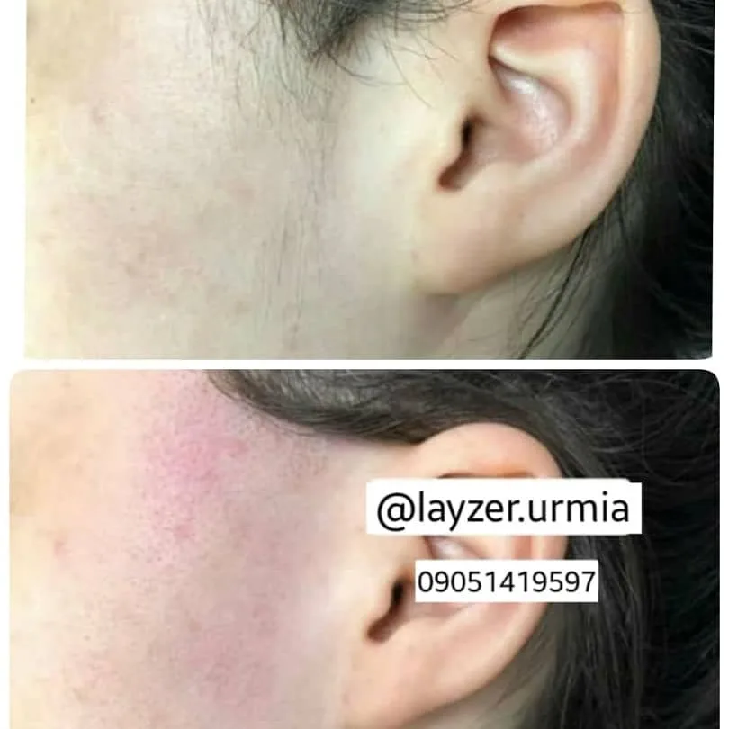 نمونه لیزر کلینیک زیبایی اورمیا لیزر ارومیه