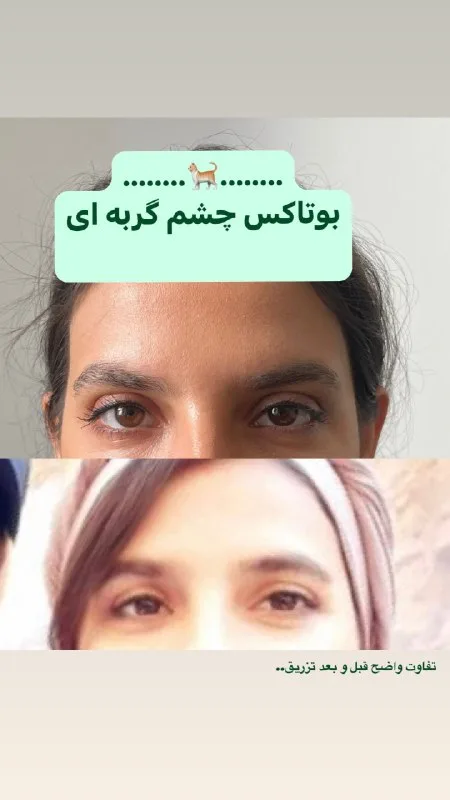 نمونه بوتاکس کلینیک زیبایی گلدن رز ارومیه