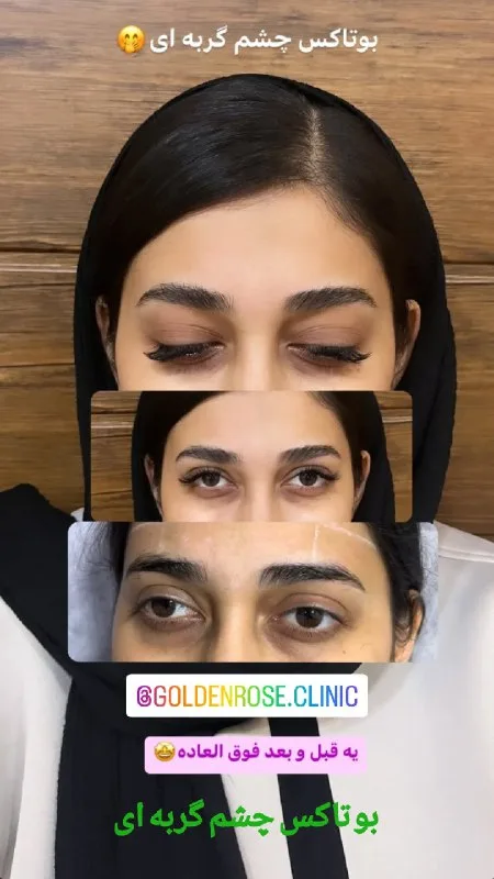نمونه بوتاکس کلینیک زیبایی گلدن رز ارومیه