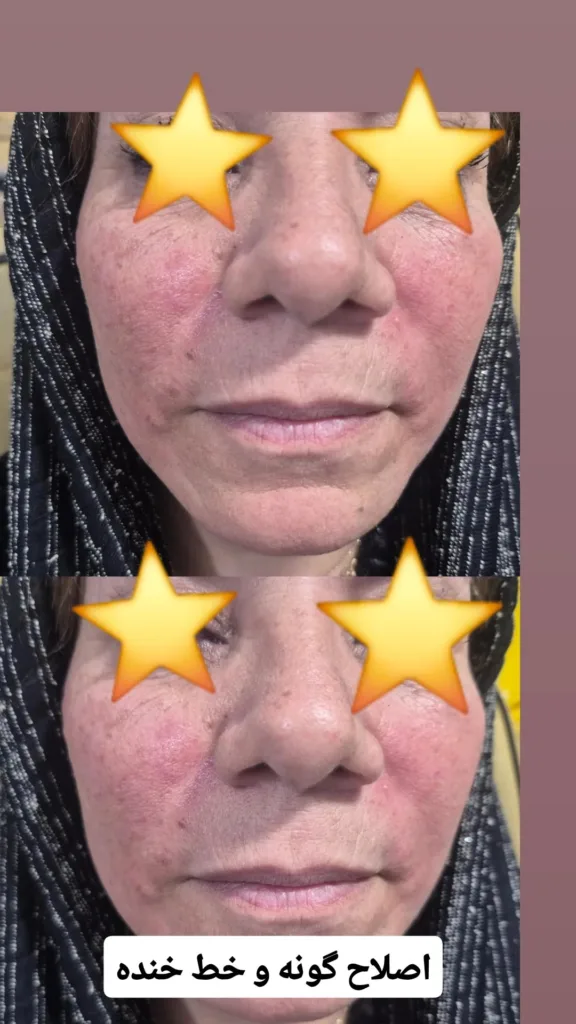 نمونه اصلاح گونه و خط خنده کلینیک زیبایی دکتر وحید حیدری ارومیه