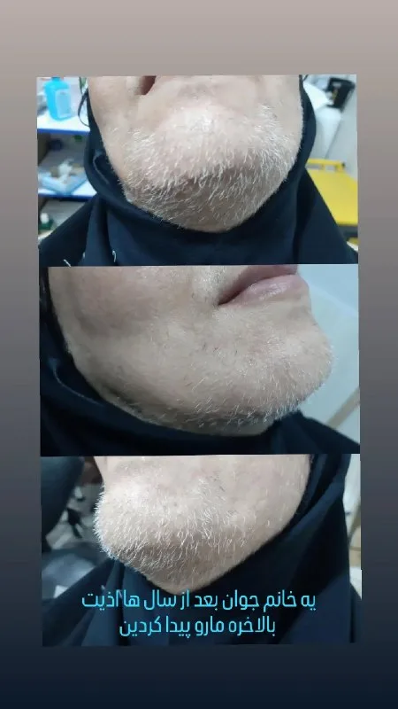 نمونه لیزر موی سفید کلینیک زیبایی دکتر وحید حیدری ارومیه