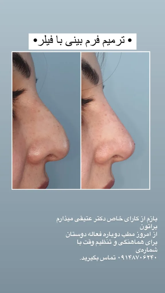 نمونه ترمیم فرم بینی با فیلر کلینیک زیبایی دکتر فرخ آذری کیا ارومیه