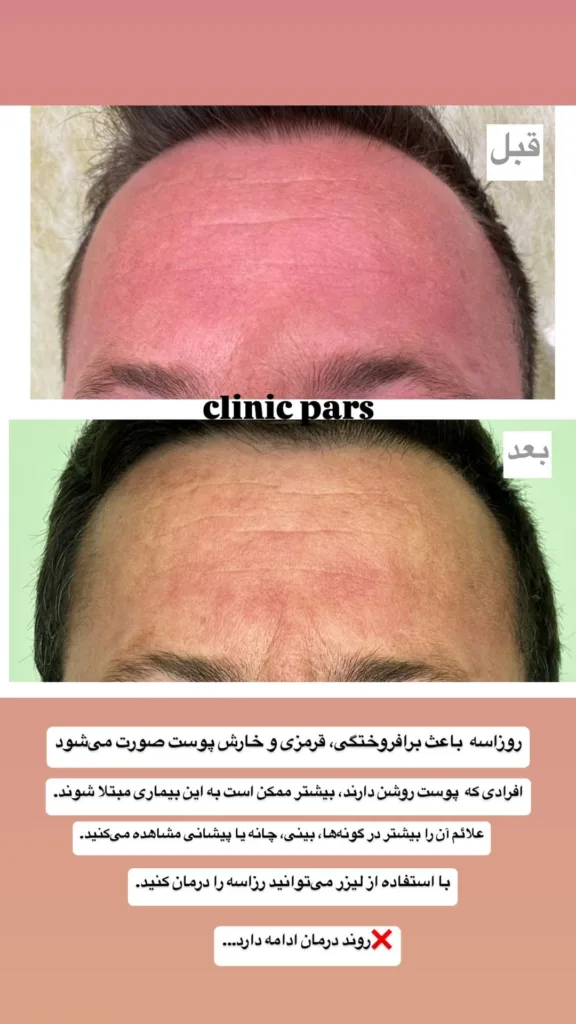 نمونه لیزر عروق کلینیک زیبایی پارس (دکتر صمدی) همدان