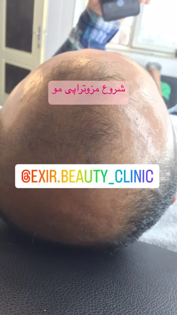 نمونه مزوتراپی کلینیک زیبایی اکسیر ساری