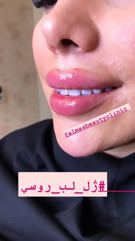 نمونه تزریق ژل لب کلینیک زیبایی الماس رشت