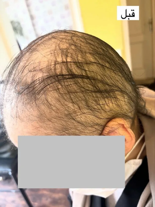 نمونه کاشت مو کلینیک تخصصی پوست و موی به سیما گرگان