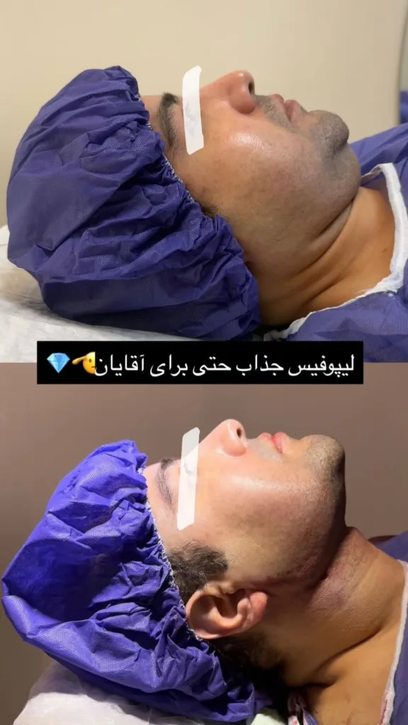 نمونه لیپوفیس کلینیک لیزر و زیبایی ماه (دکتر توانگر) یاسوج