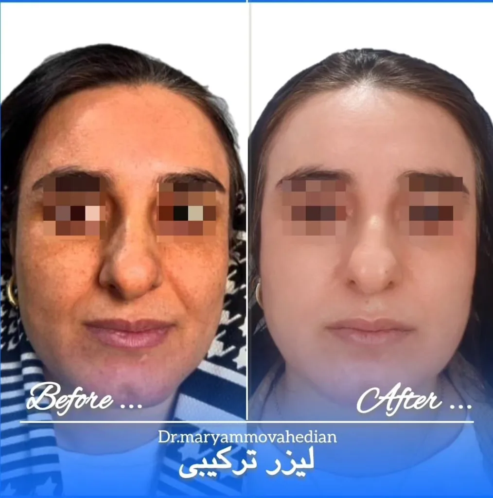 نمونه لیزر ترکیبی مطب دکتر مریم موحدیان یاسوج