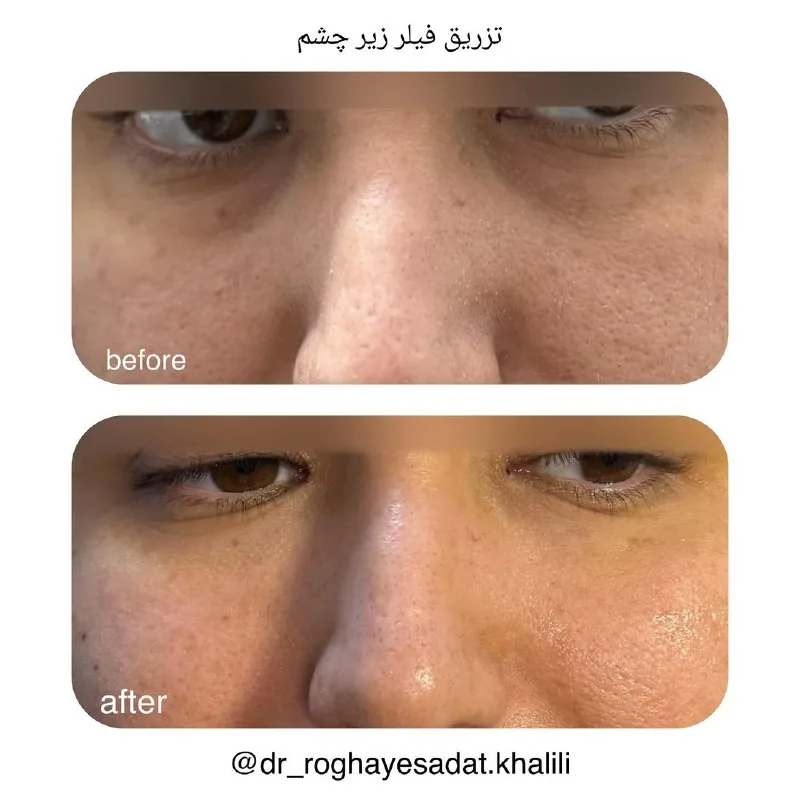 نمونه فیلر زیر چشم مطب دکتر رقیه سادات خلیلی تمبی یاسوج