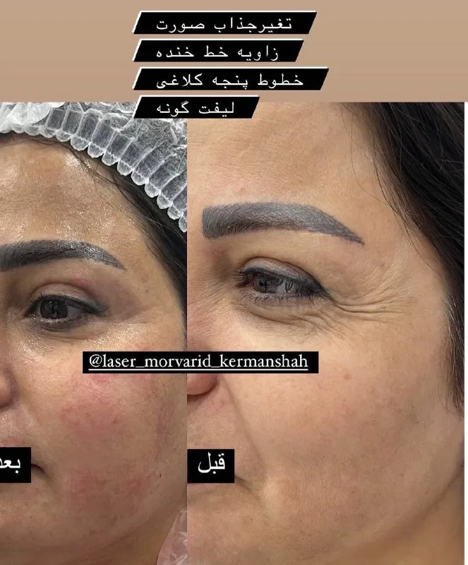 نمونه لیفت گونه مرکز لیزر و زیبایی مروارید کرمانشاه