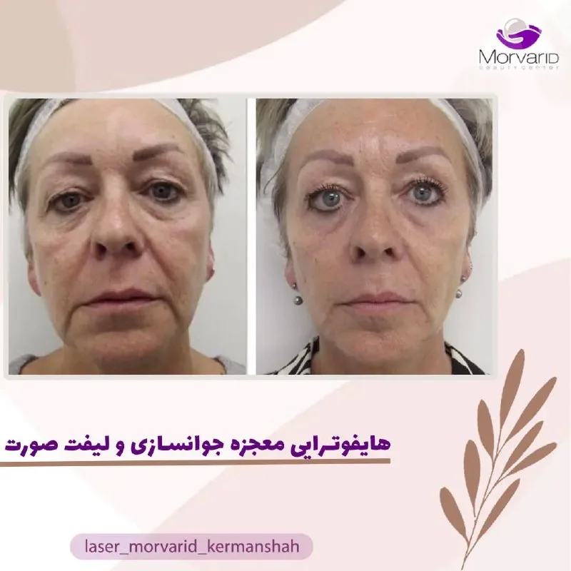 نمونه هایفوتراپی مرکز لیزر و زیبایی مروارید کرمانشاه