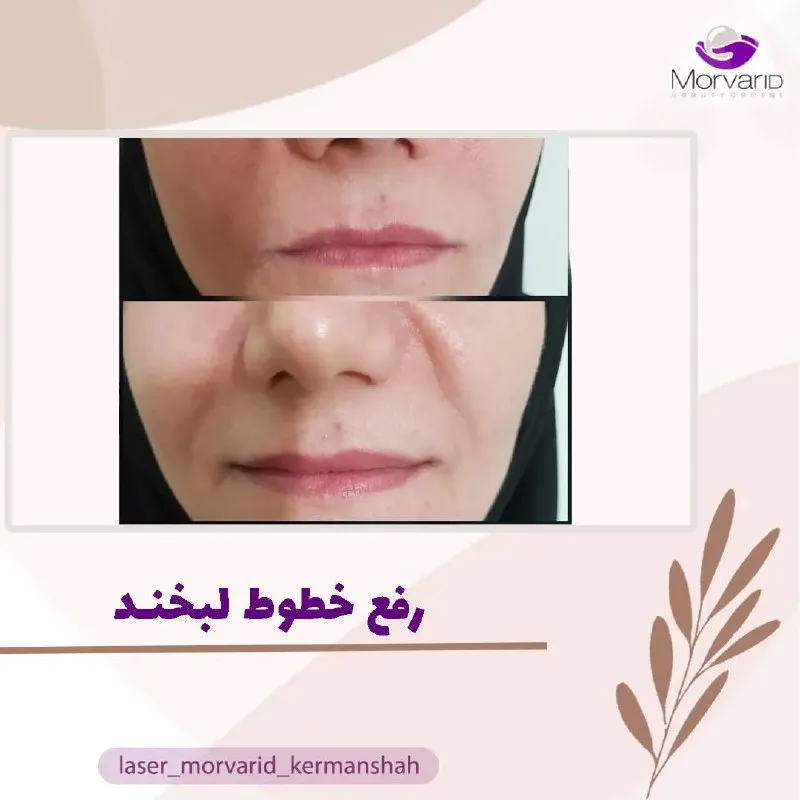 نمونه رفع خطوط لبخند مرکز لیزر و زیبایی مروارید کرمانشاه