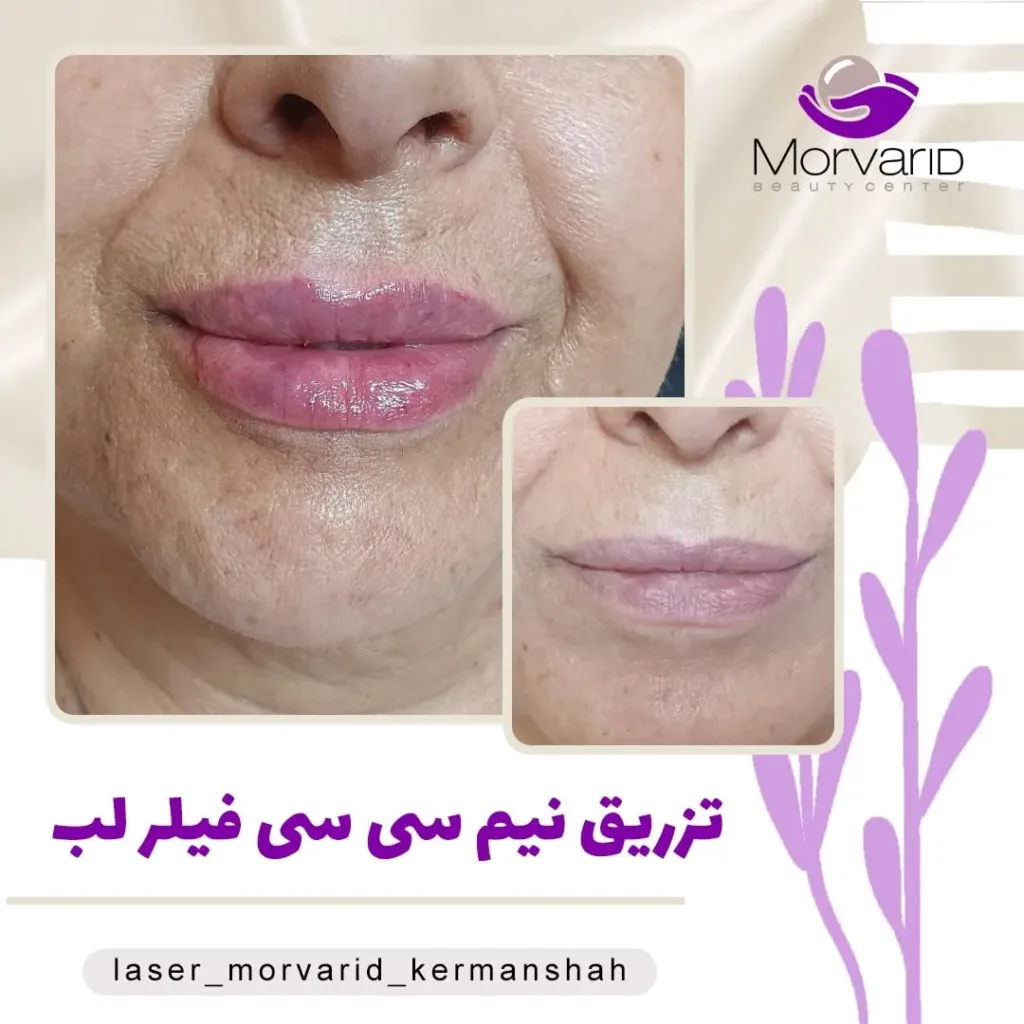 نمونه تزریق فیلر لب مرکز لیزر و زیبایی مروارید کرمانشاه