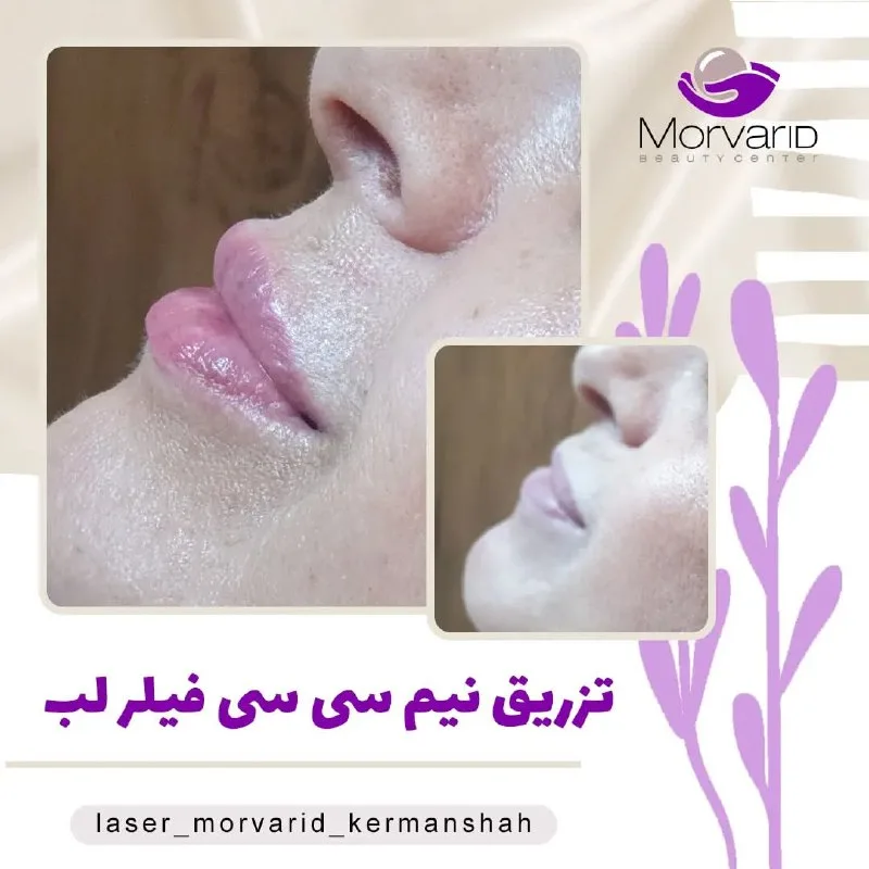نمونه تزریق فیلر لب مرکز لیزر و زیبایی مروارید کرمانشاه