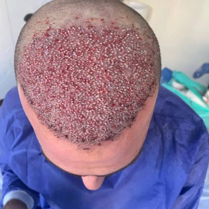 نمونه کاشت کلینیک زیبایی دکتر فاطمه احمدآقایی کرمانشاه