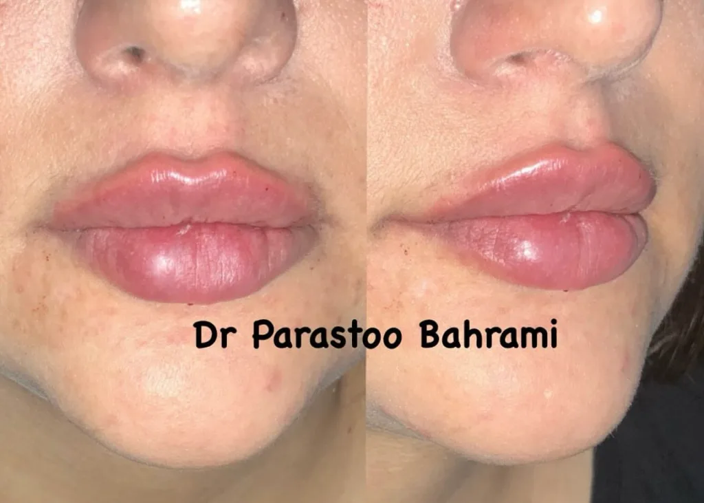 نمونه فیلر لب کلینیک زیبایی به سیما (دکتر پرستو بهرامی) کرمانشاه