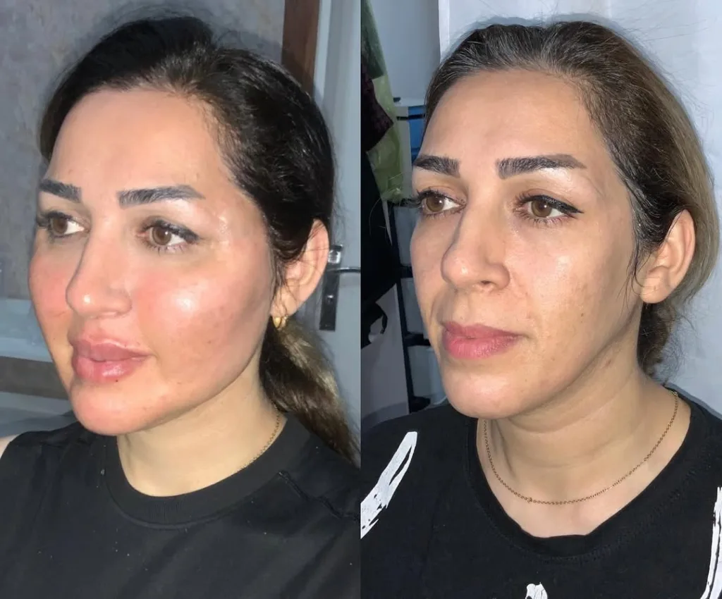 نمونه تزريق چربى کلینیک زیبایی به سیما (دکتر پرستو بهرامی) کرمانشاه