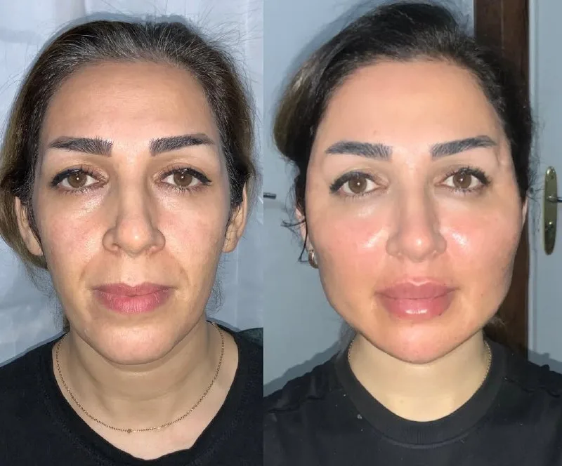 نمونه تزريق چربى کلینیک زیبایی به سیما (دکتر پرستو بهرامی) کرمانشاه