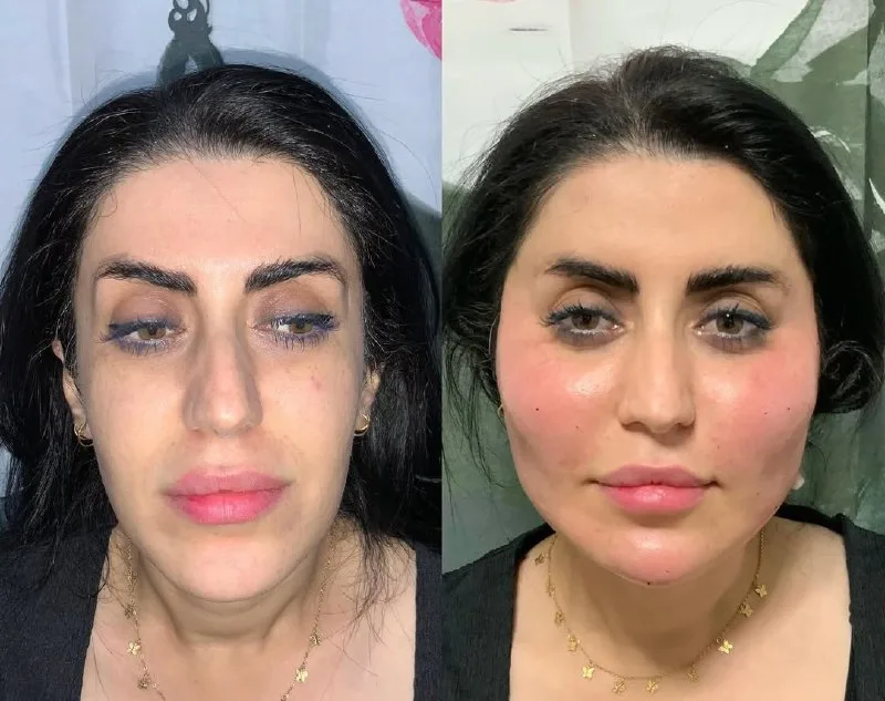نمونه تزريق چربى کلینیک زیبایی به سیما (دکتر پرستو بهرامی) کرمانشاه
