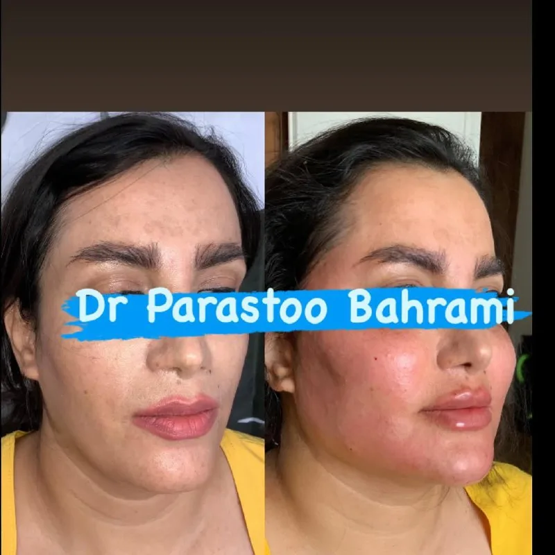 نمونه تزريق چربى کلینیک زیبایی به سیما (دکتر پرستو بهرامی) کرمانشاه