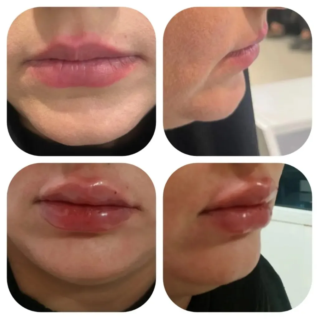 نمونه فیلر لب کلینیک زیبایی دکتر شهلا نعمتی کرمانشاه