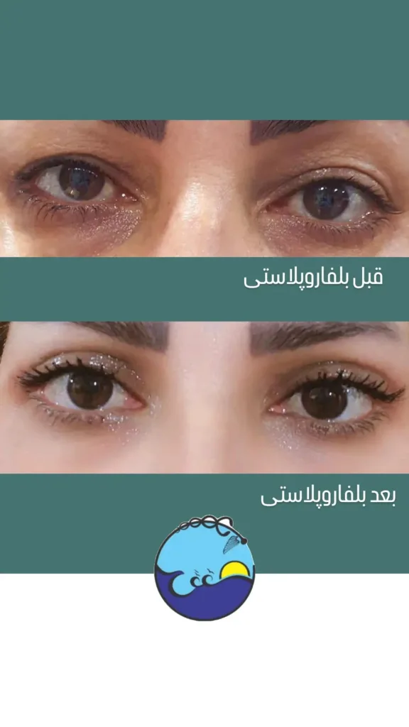 نمونه بلفاروپلاستی نمونه کار کلینیک زیبایی دکتر رامک ممتاز کرمانشاه