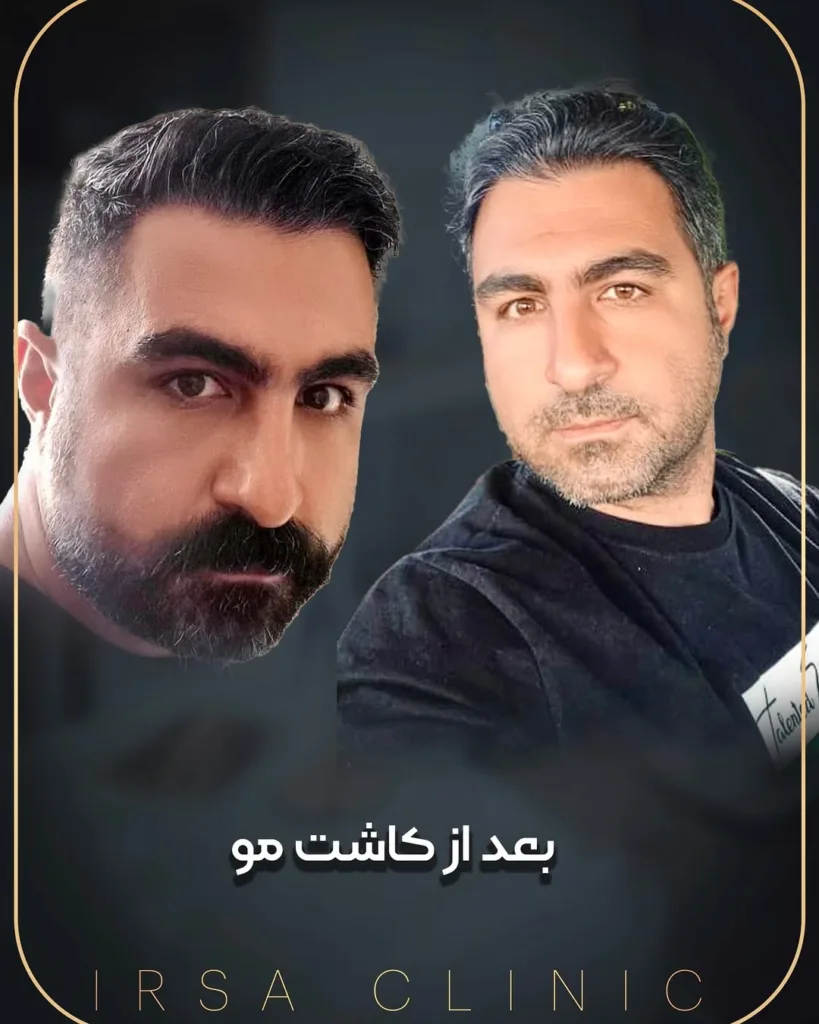 نمونه کاشت مو کلینیک تخصصی پوست و موی ایرسا شیراز