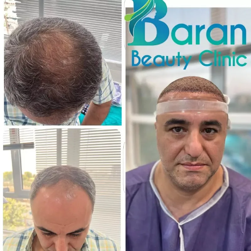 نمونه کاشت مو کلینیک زیبایی باران شیراز