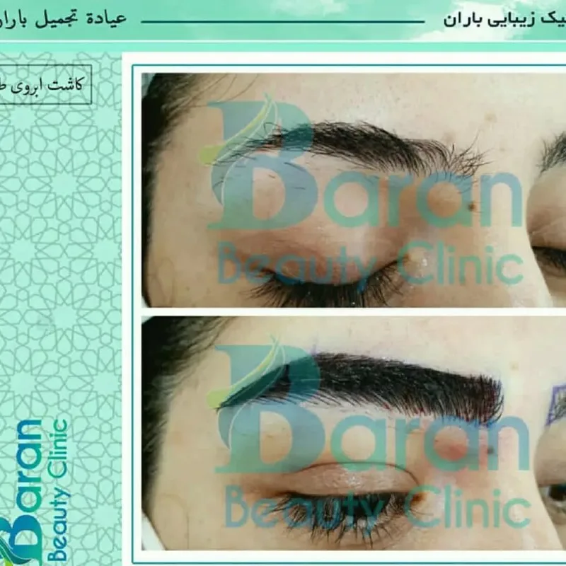 نمونه کاشت ابرو کلینیک زیبایی باران شیراز