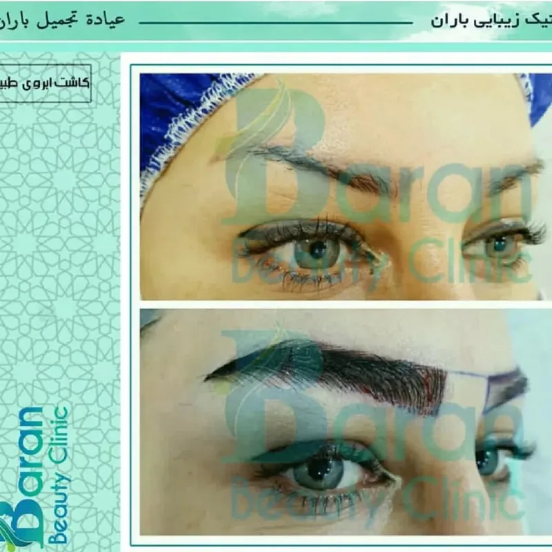 نمونه کاشت ابرو کلینیک زیبایی باران شیراز