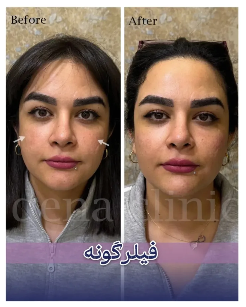 نمونه کار نمونه کاشت مو کلینیک زیبایی باران شیراز